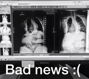 Picture of Max 's scoliosis monitoring x-ray in Sept 2015